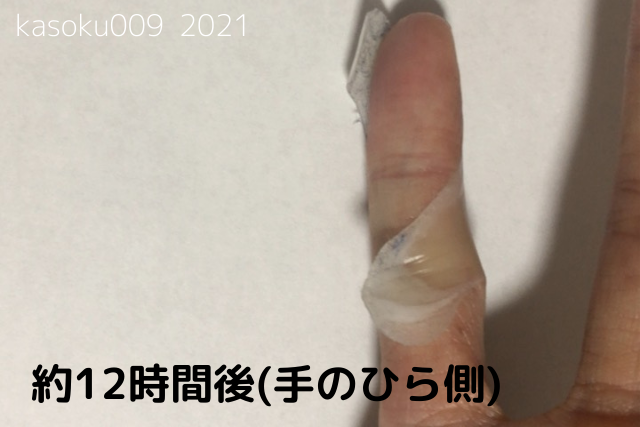 アトピーの僕がキズパワーパッドの効果を検証してみた 写真付き Kasoku009の雑記ブログ